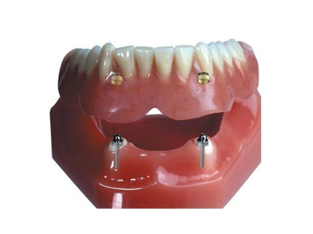 Implant Overdenture Pink City
