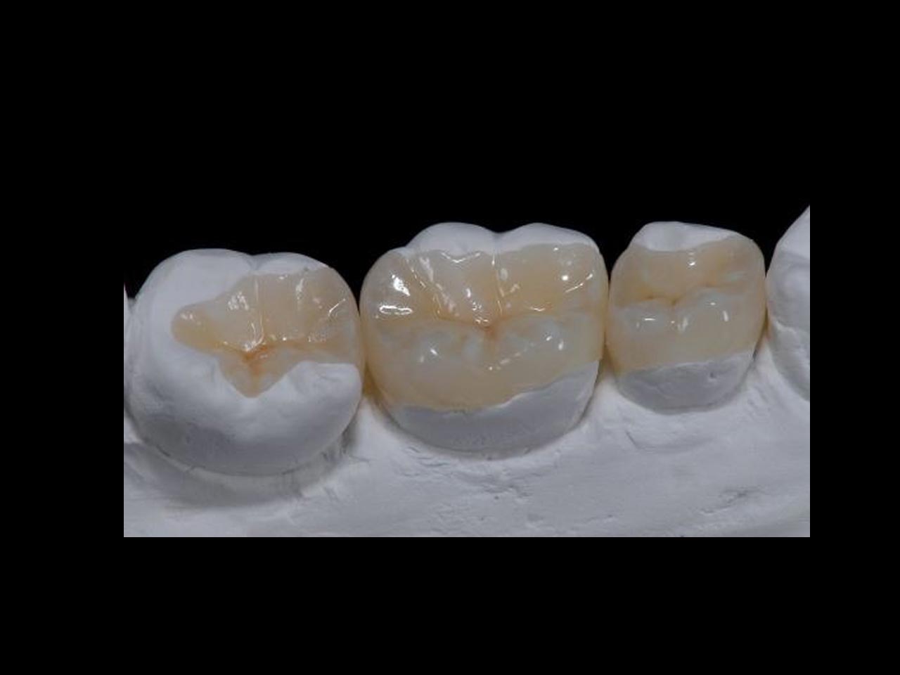 INLAYS/ONLAYS Pink City